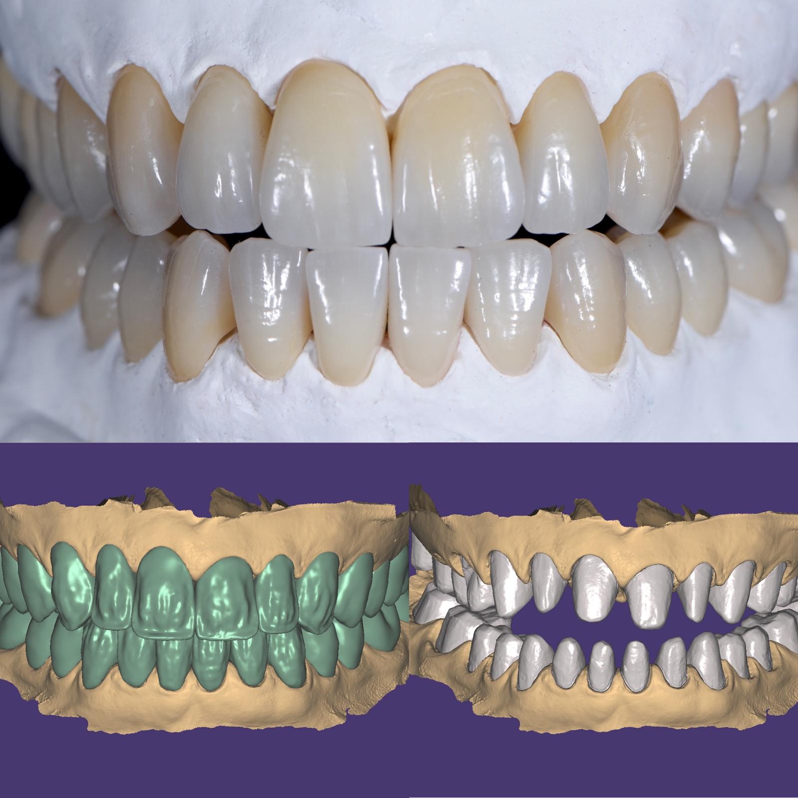 Protesi superiore e inferiore