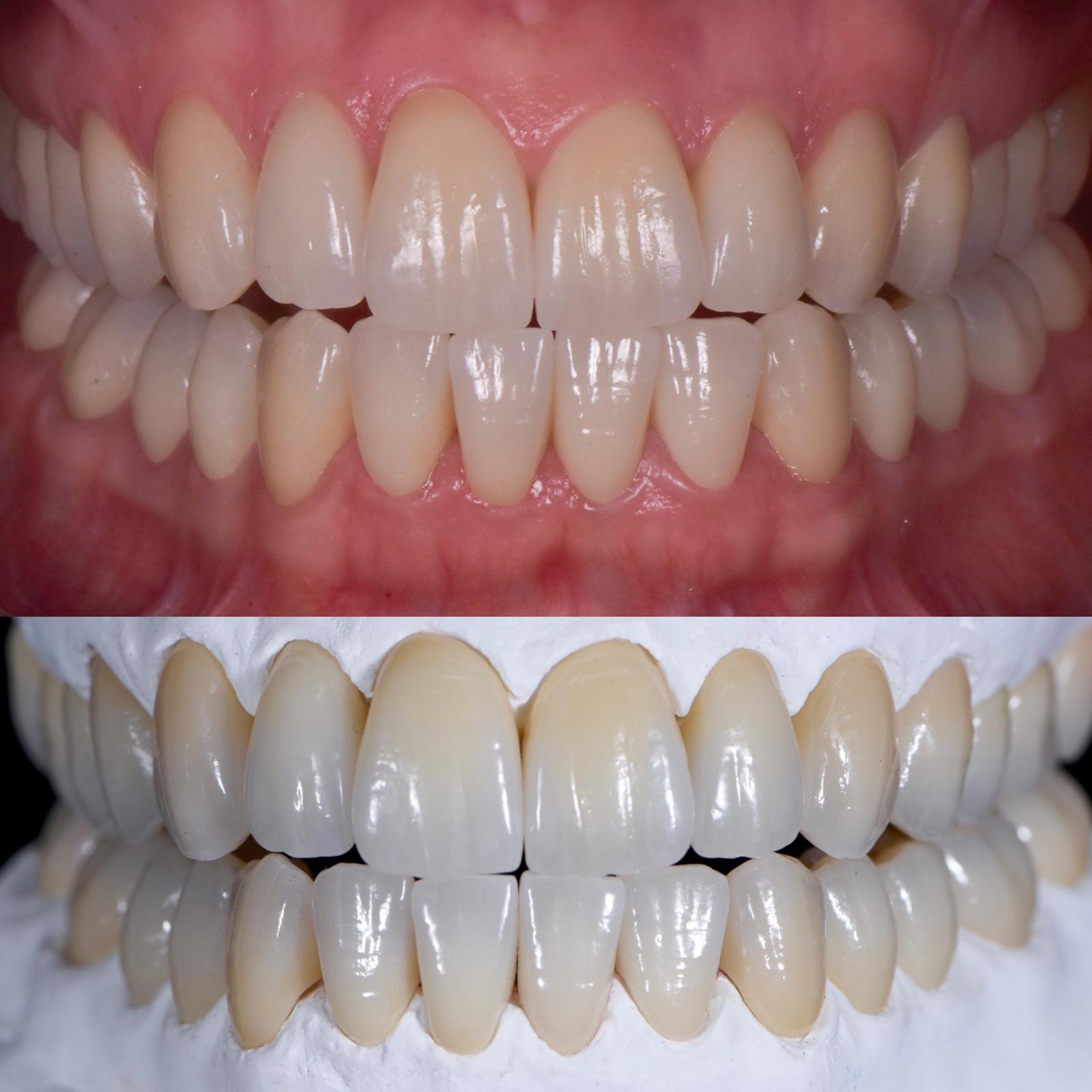 Immagine clinica con protesi superiore e inferiore